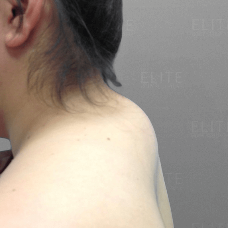Buffalo Hump AirSculpt Before