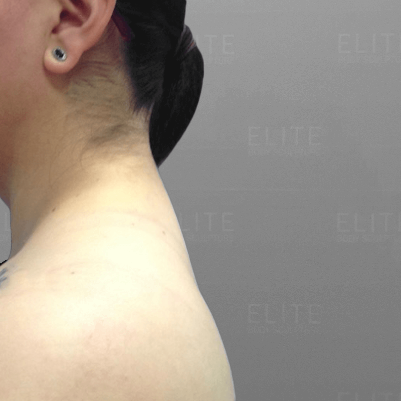 Buffalo Hump AirSculpt After