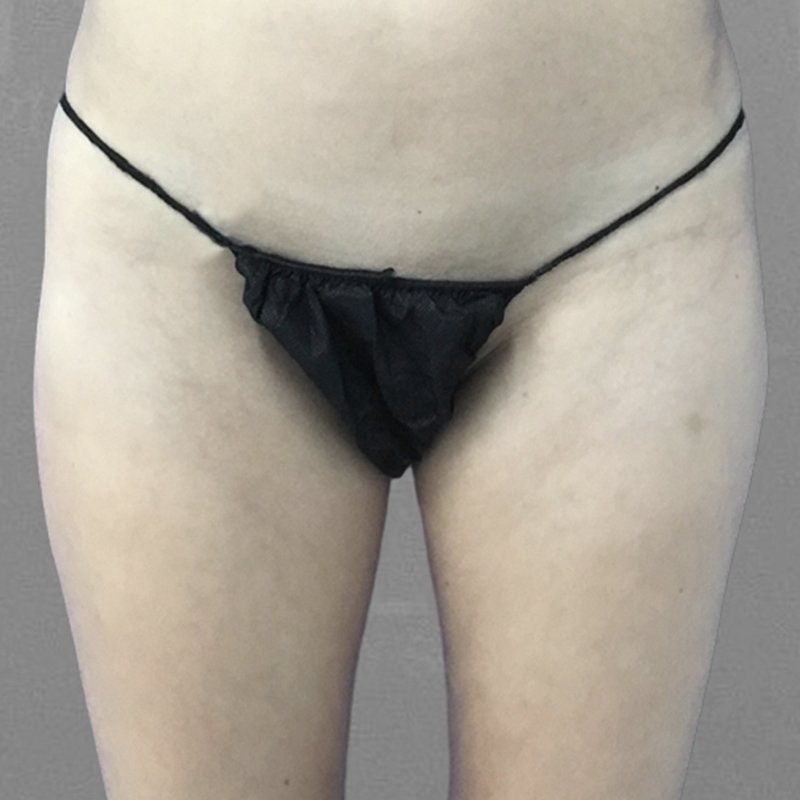 Thigh Lipedema Treatement Before