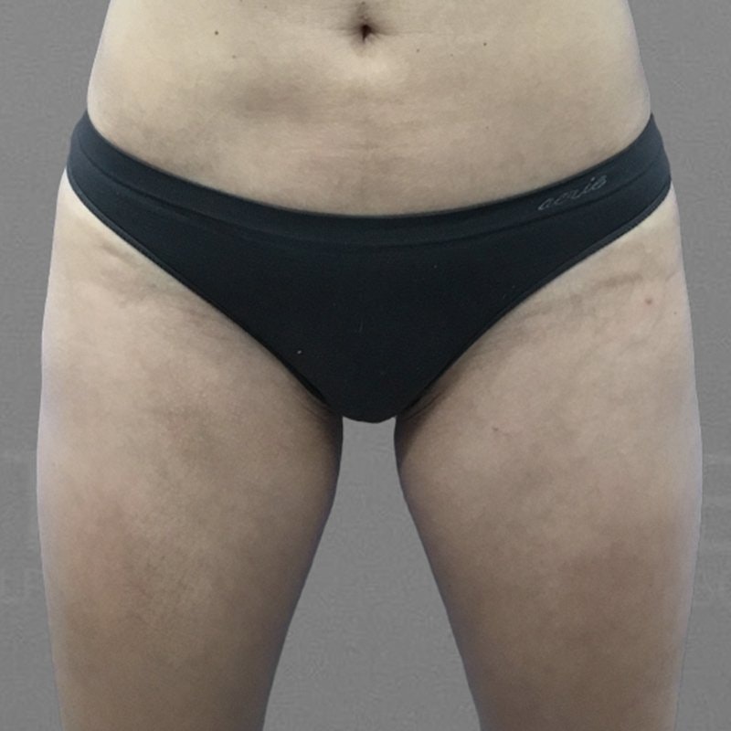 Thigh Lipedema Treatement After