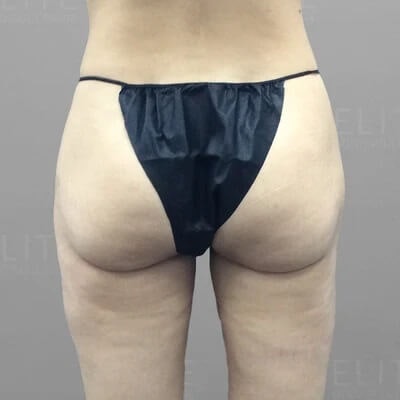 Thigh Lipedema Treatement After 3