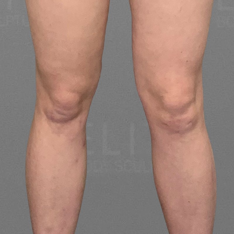 Beverly Hills Knee Liposuction | AirSculptĀ® Knee Fat Removal