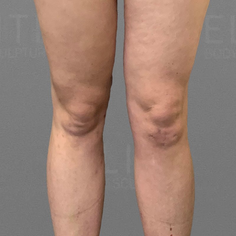 Knee Fat Removal After