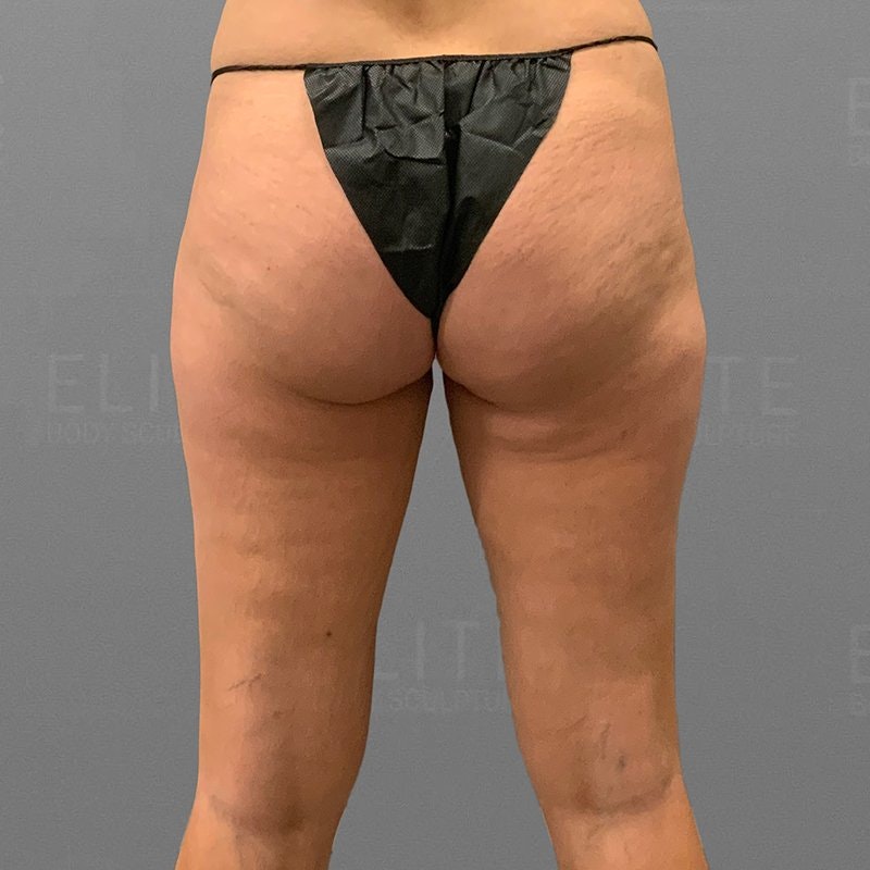 Outer Thigh Sculpt Before