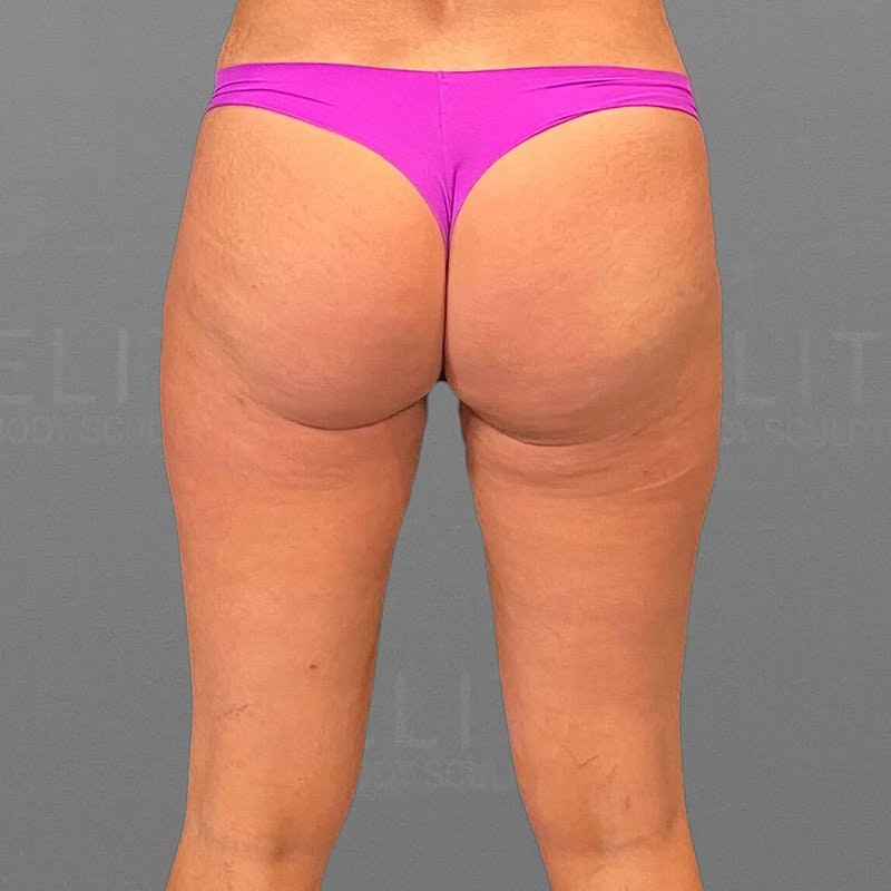 Outer Thigh Sculpt After