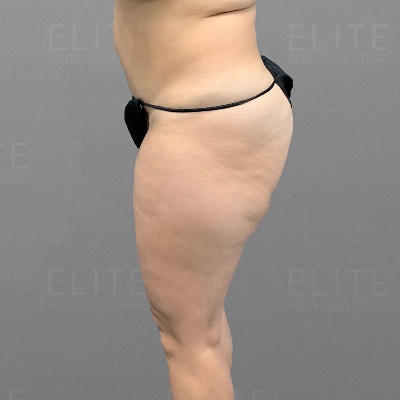 Banana Roll AirSculpt Before