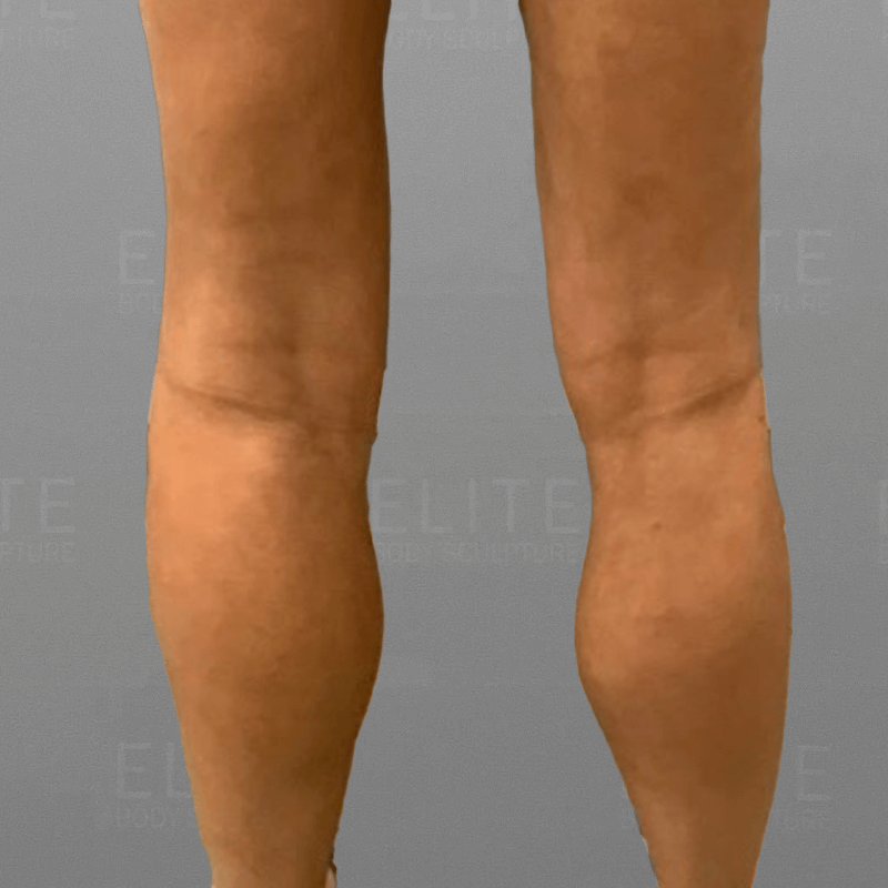 Cankle Fat Removal Before