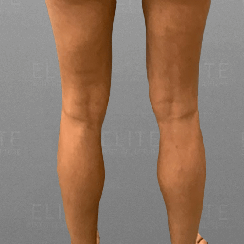 Cankle Fat Removal After