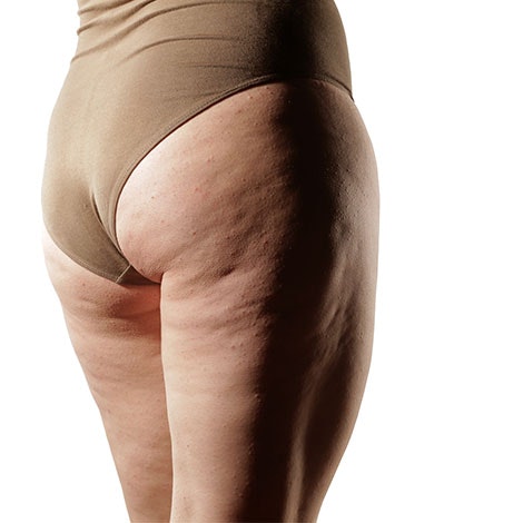 Smooth Away Liposuction Mistakes