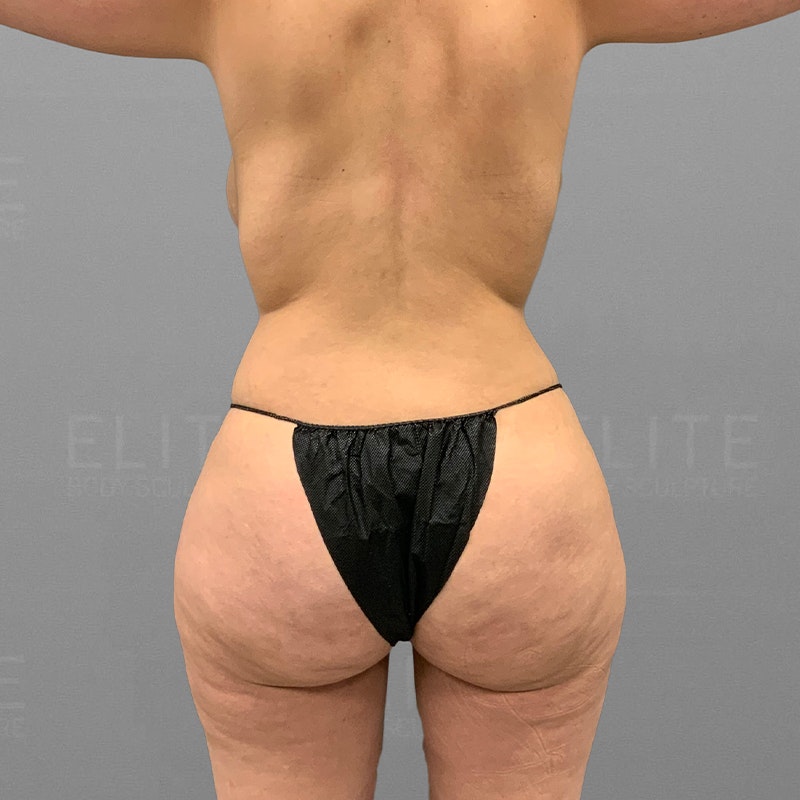 Liposcution Revision After