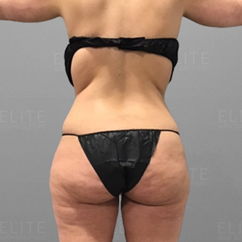 Liposcution Revision Before