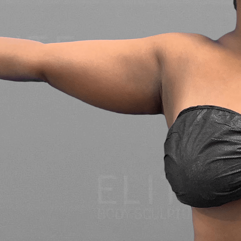 Underarm AirSculpt Before