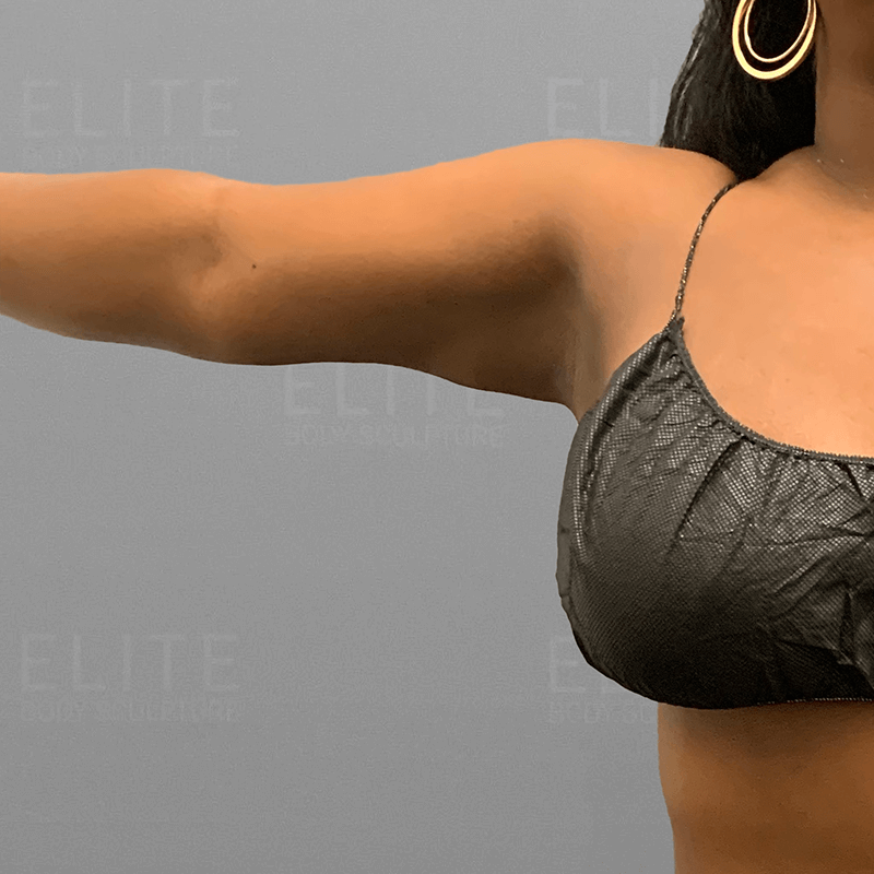 Underarm AirSculpt After