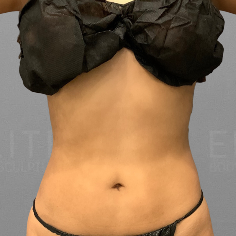 Front Bra Roll AirSculpt After