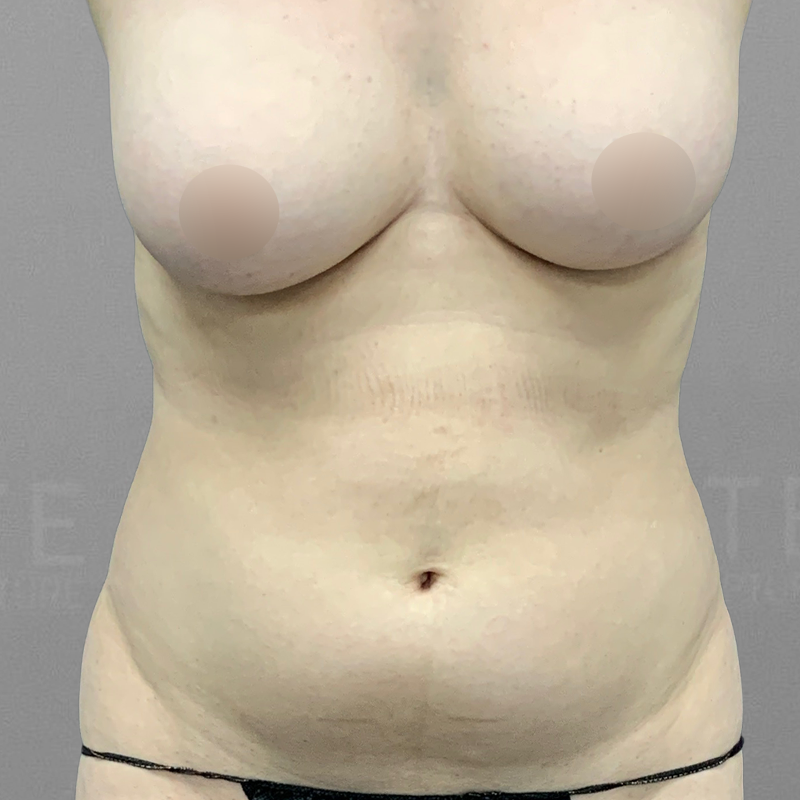 Front Bra Roll AirSculpt Before 2