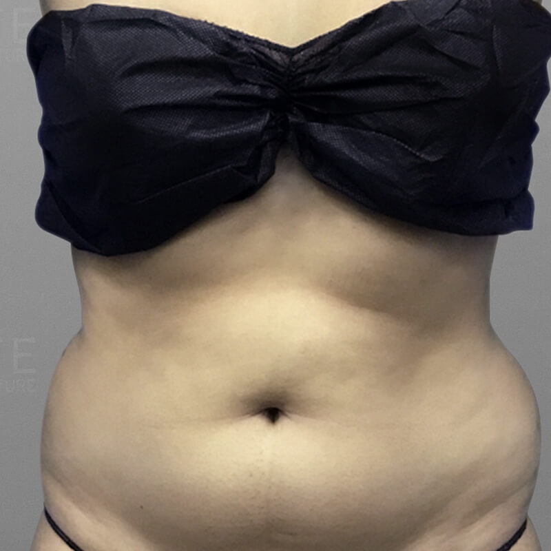 Stomach Sculpting Before