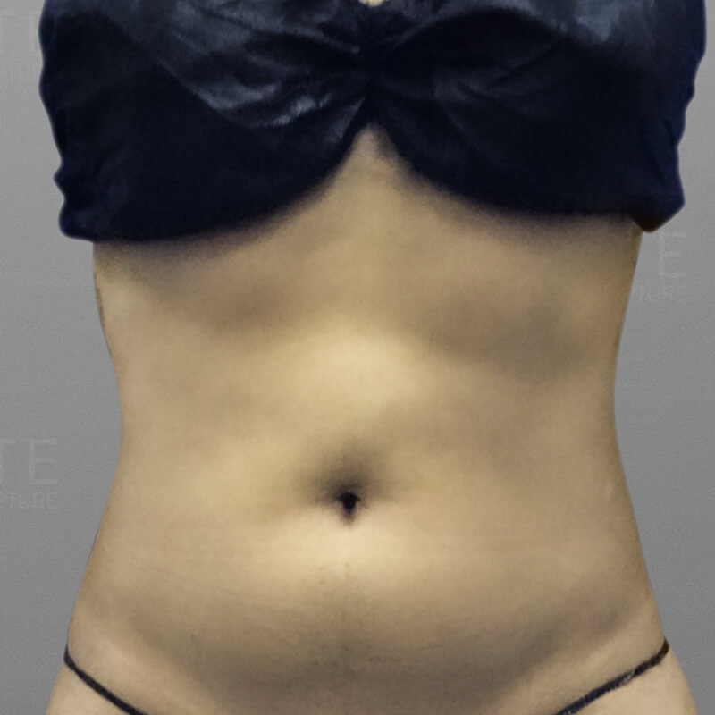 Stomach Sculpting After