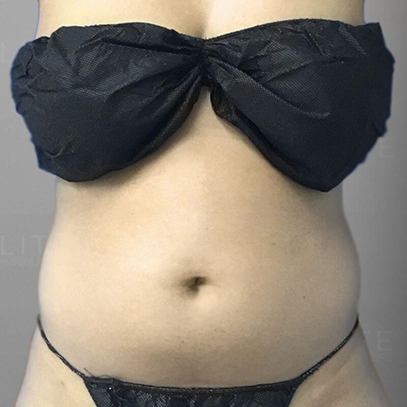 Stomach Sculpting Before 2