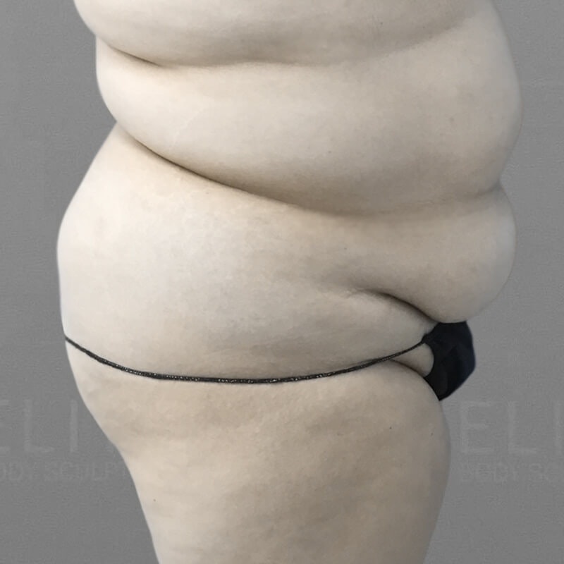 Stomach Sculpting Before 3