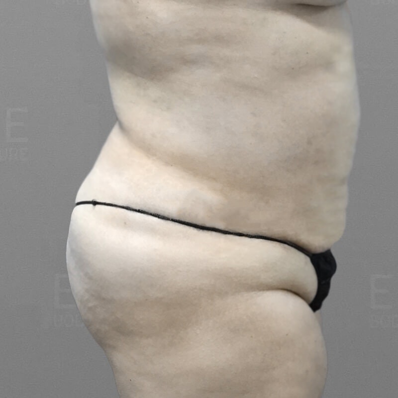 Stomach Sculpting After 3