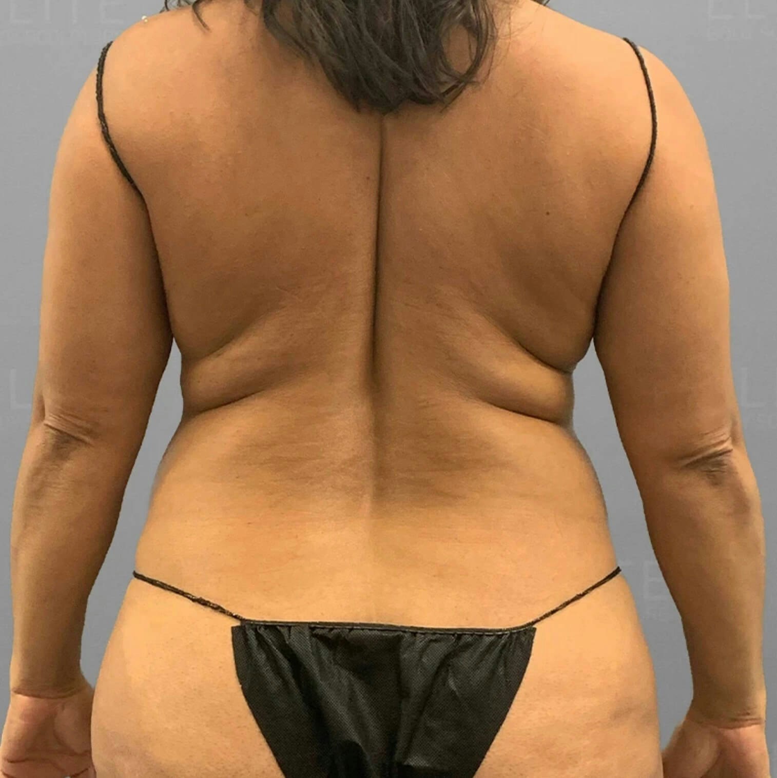 Back AirSculpt Before