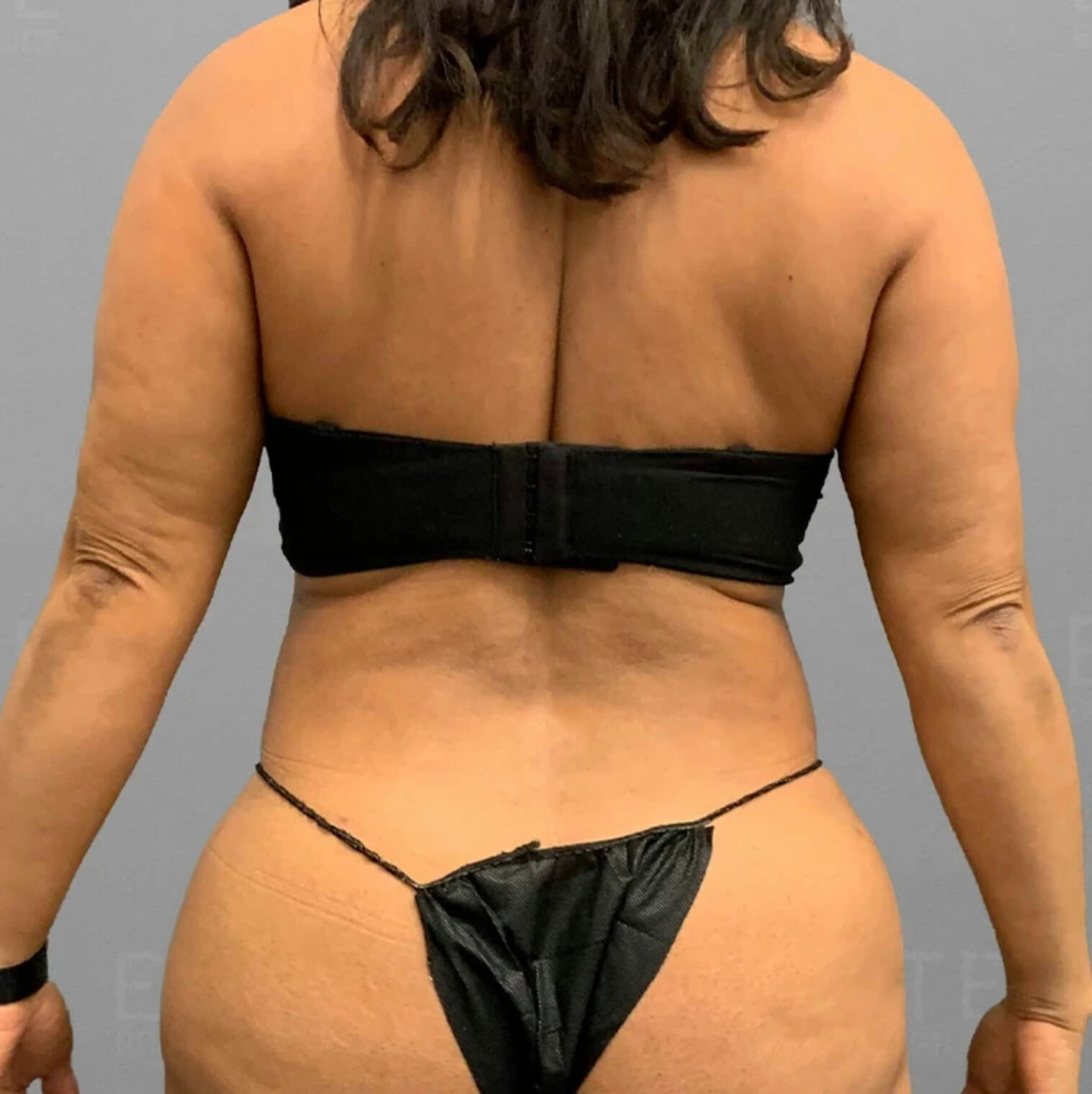 Back AirSculpt After