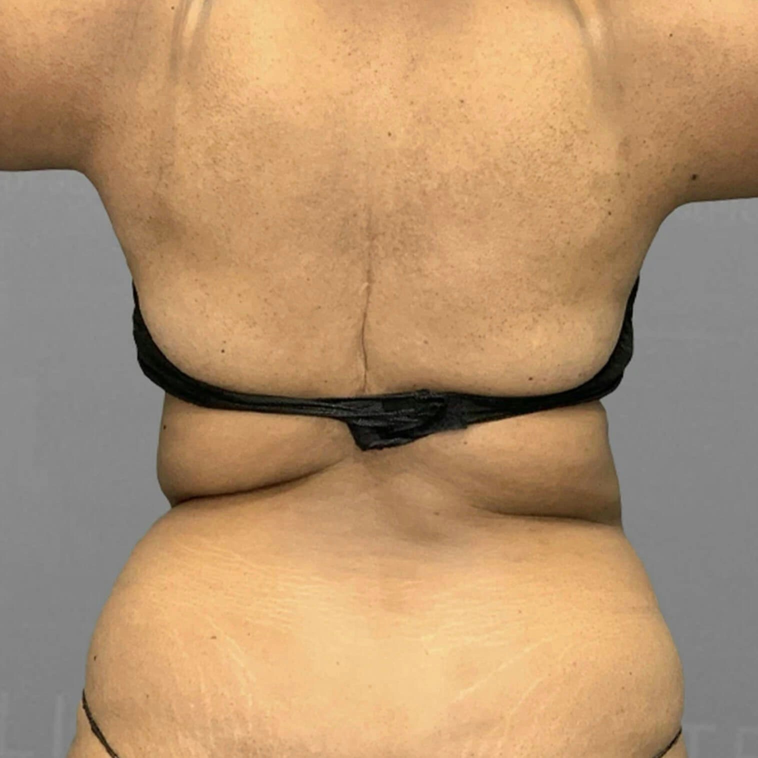 Back AirSculpt Before 2