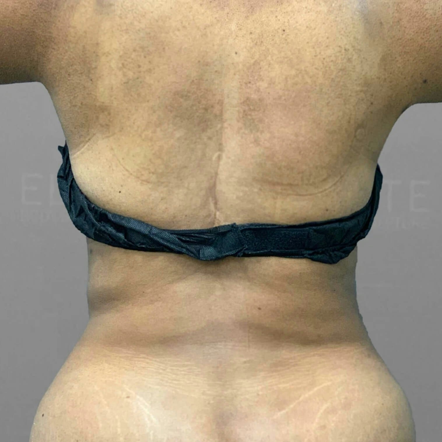 Back AirSculpt After 2