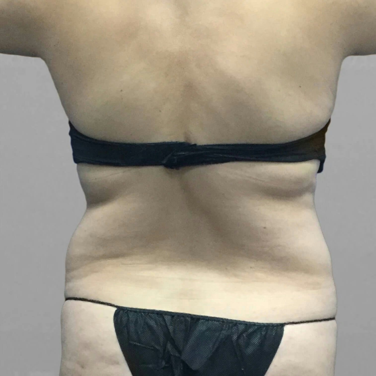 Back AirSculpt Before 3