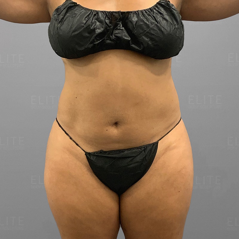 Pubic AirSculpt Before