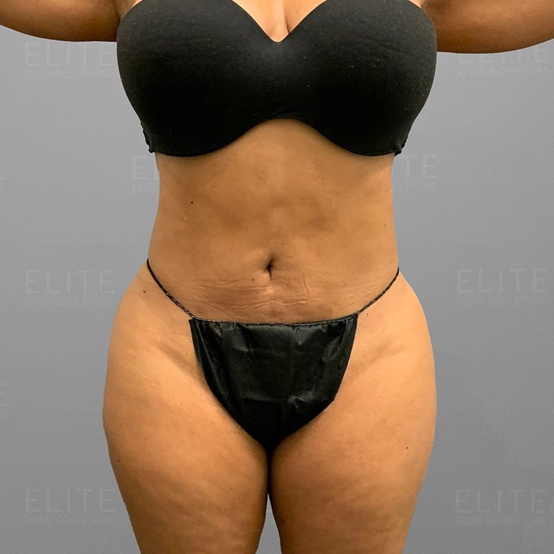 Pubic AirSculpt After