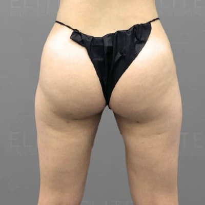 Leg AirSculpt After