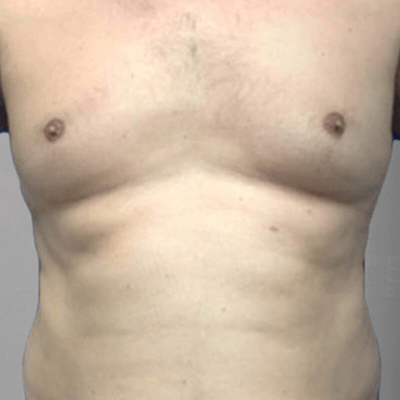 Gynecomastia Before