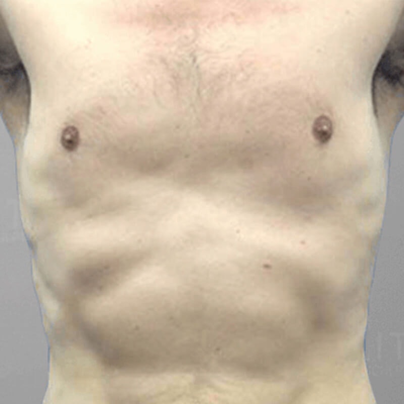 Gynecomastia After