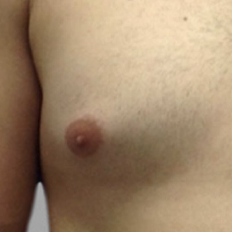 Gynecomastia Before 2