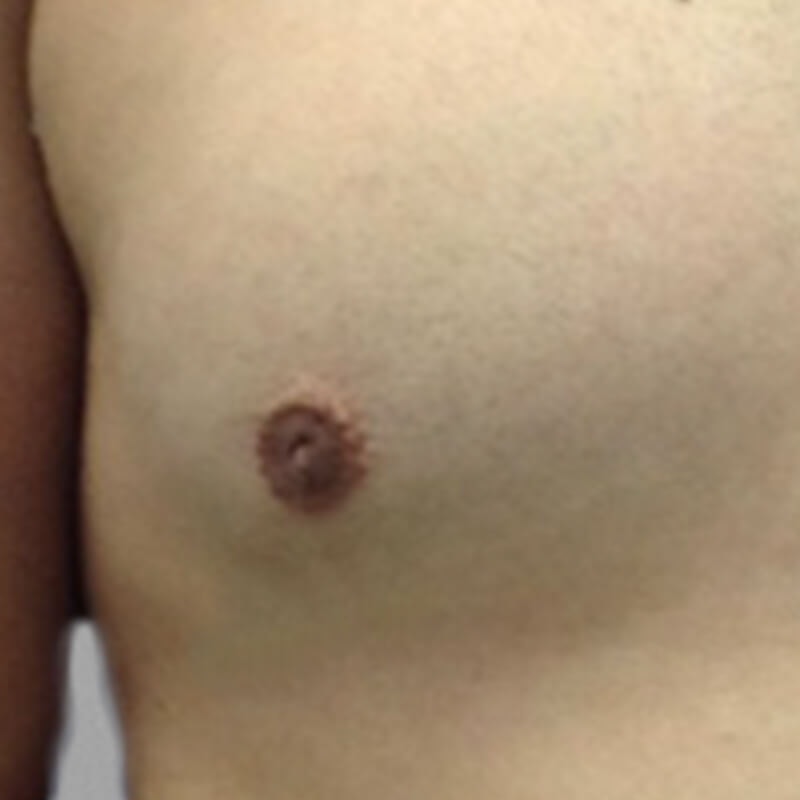 Gynecomastia After 2