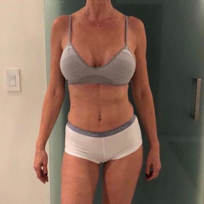 Mommy Makeover After