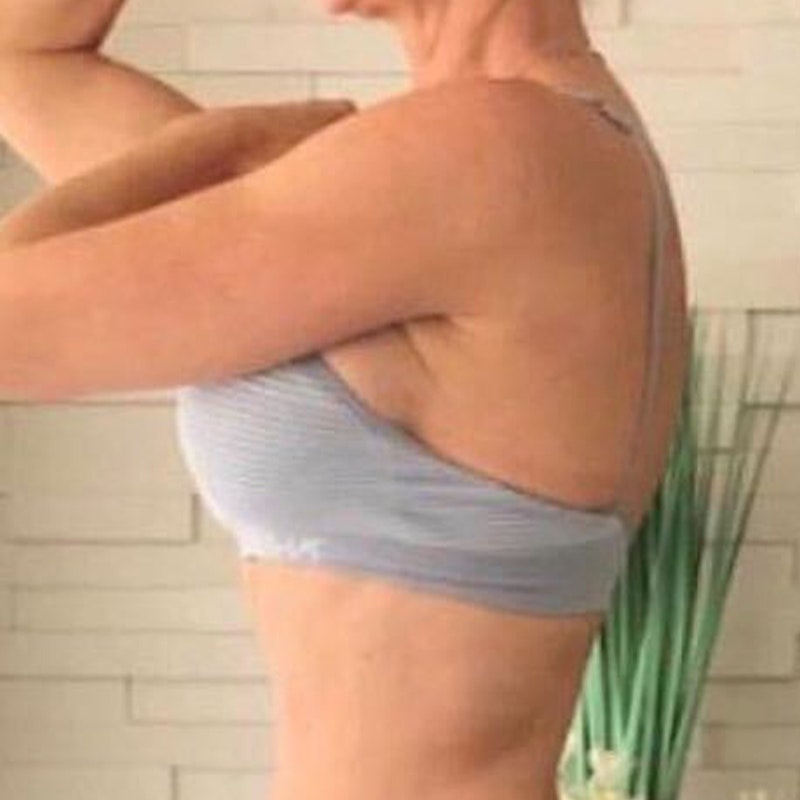 Mommy Makeover After 3