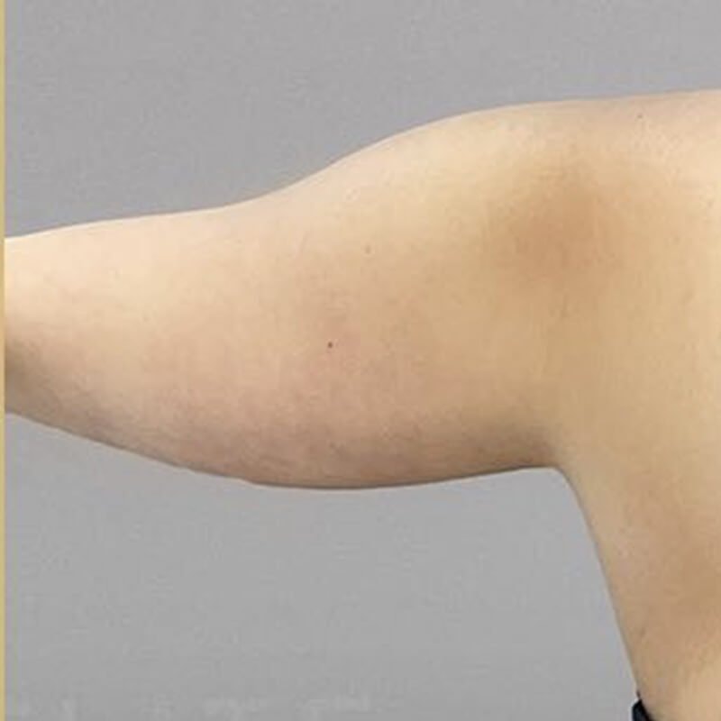 Corrective AirSculpt Before