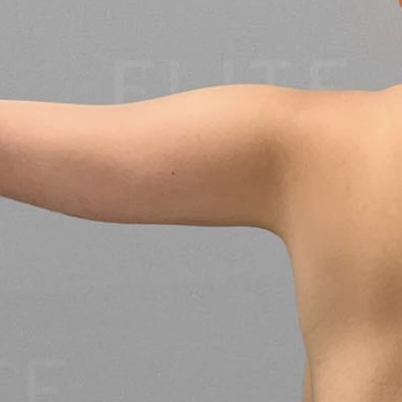 Corrective AirSculpt After