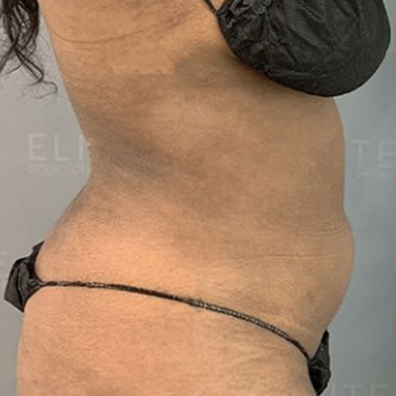 Corrective AirSculpt Before 2