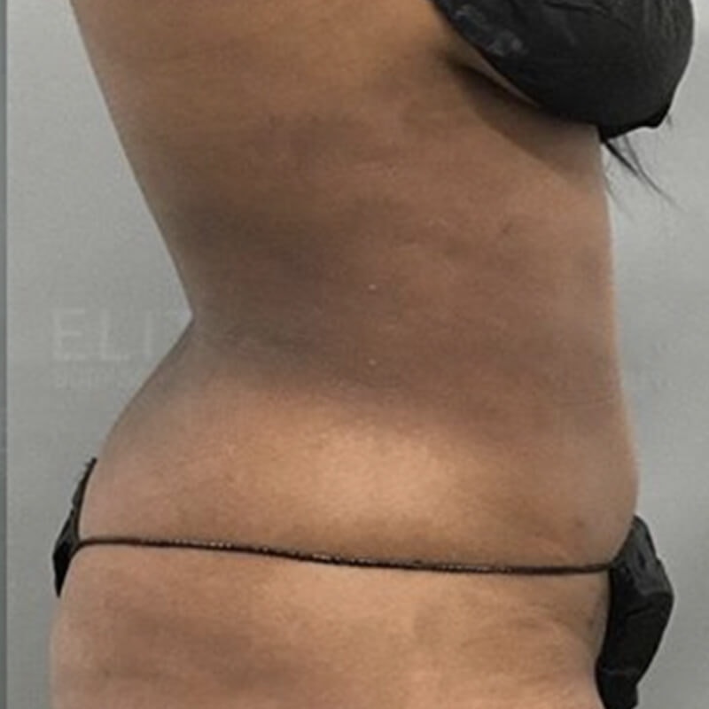 Corrective AirSculpt After 2