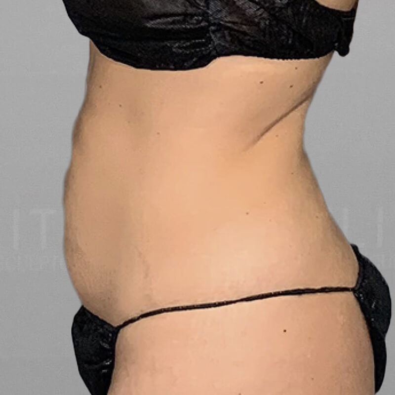 Tummy Tuck - Corrective/Revision Before and After Results - Houston, TX