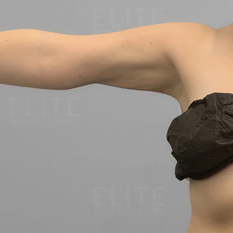 Arm AirSculpt Before