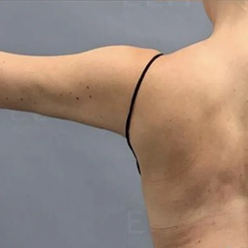 Arm AirSculpt After 2