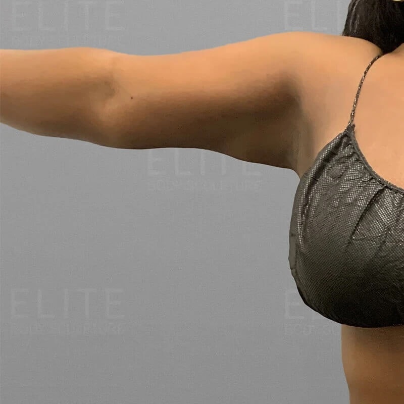 Arm AirSculpt After 3