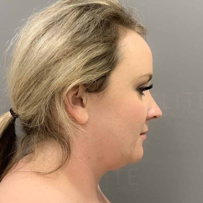 Chin Fat Removal Before