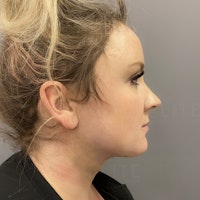 Chicago Double Chin Surgery | AirSculpt® Chin Liposuction