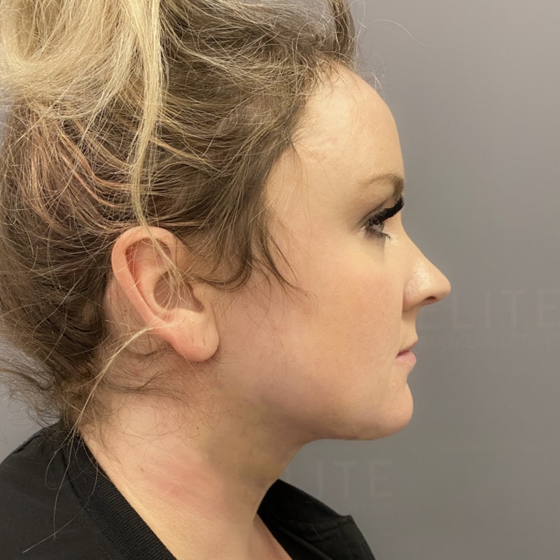 Chin Fat Removal After