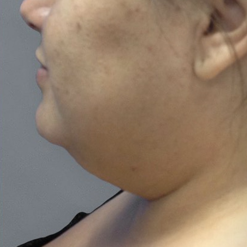 Chin Fat Removal Before 2